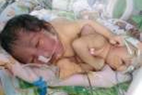 Bayi Kembar Siam yang Lahir di Toilet Akan Dioperasi Pemisahan