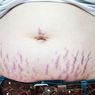 Stretch Marks