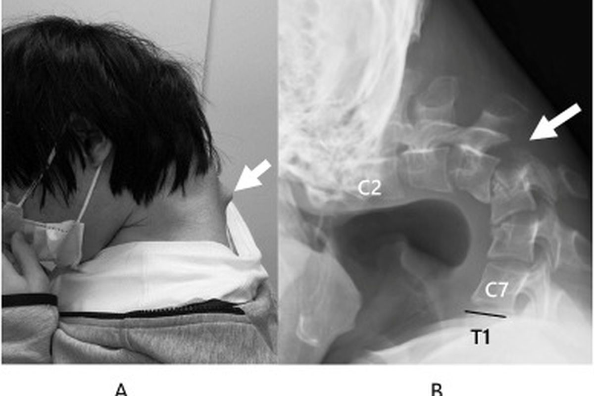 Seorang pria berusia 25 di Jepang mengalai sindrom kepala tertunduk atau Dropped Head Syndrome (DHS) karena terlalu sering bermain handphone dengan kepala menunduk.