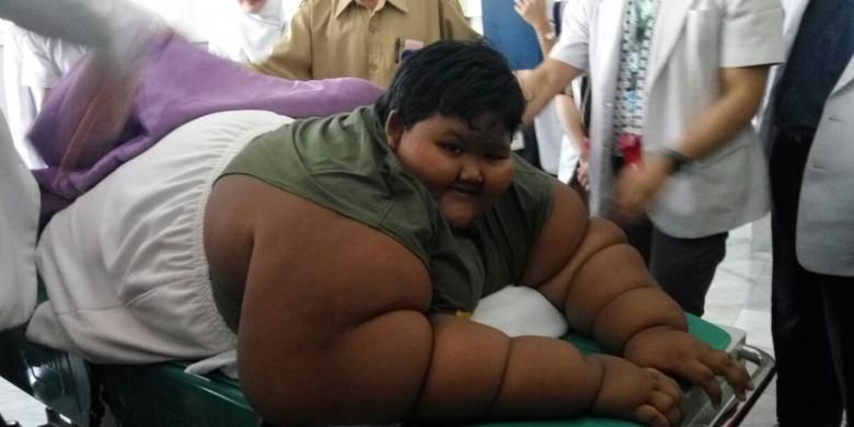 Arya Permana (10) penderita severe obesity ditangani 13 dokter spesialis RSHS. Berat badan normal Arya kurang dari 50 kg, namun saat ini beratnya mencapai 189,5 kg. 