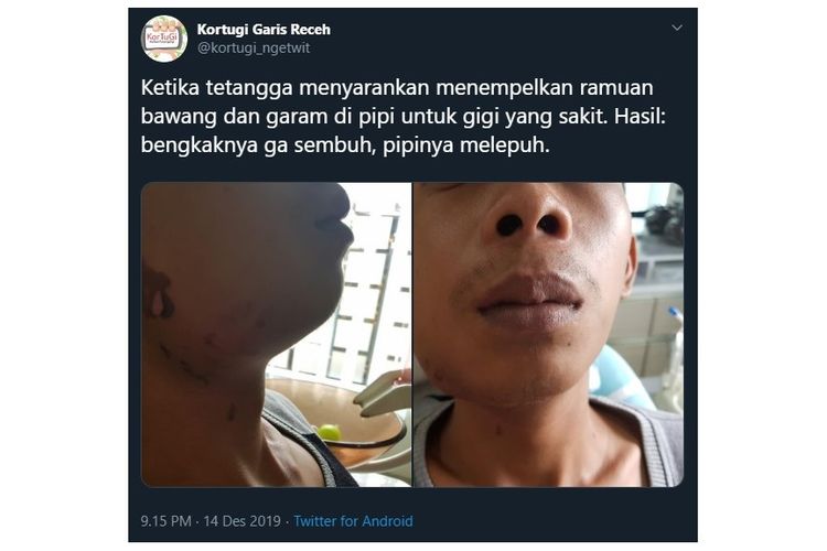Sebuah foto menampilkan warga yang alami sakit gigi dan pipi bengkak karena menggunakan ramuan bawang dan garam beredar pada Minggu (15/12/2019).