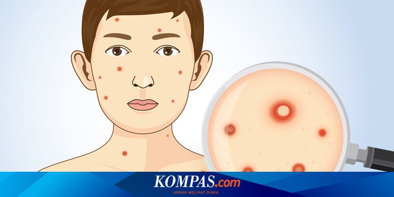 5 Ciri-ciri Infeksi HIV pada Kulit Halaman all - Kompas.com