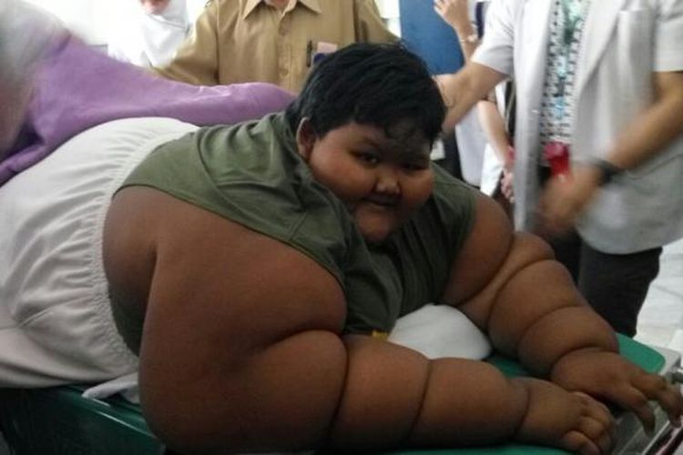 Arya Permana (10) penderita severe obesity ditangani 13 dokter spesialis RSHS. Berat badan normal Arya kurang dari 50 kg, namun saat ini beratnya mencapai 189,5 kg. 