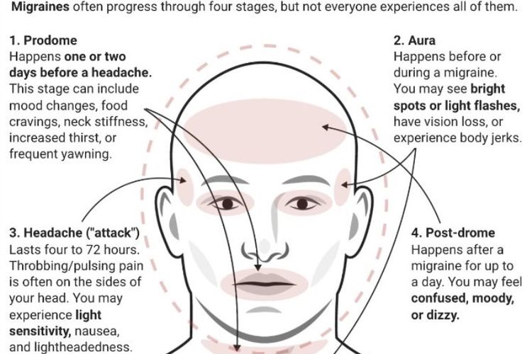 Migrain Dan Sakit Kepala Tahukah Bedanya Halaman All Kompas Com