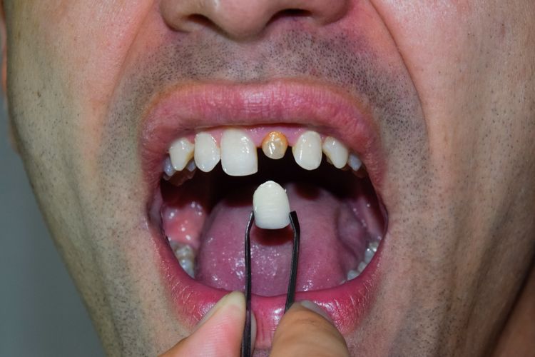 Mengetahui penyebab gigi kecil akan membantu dalam menentukan perawatan yang sesuai.