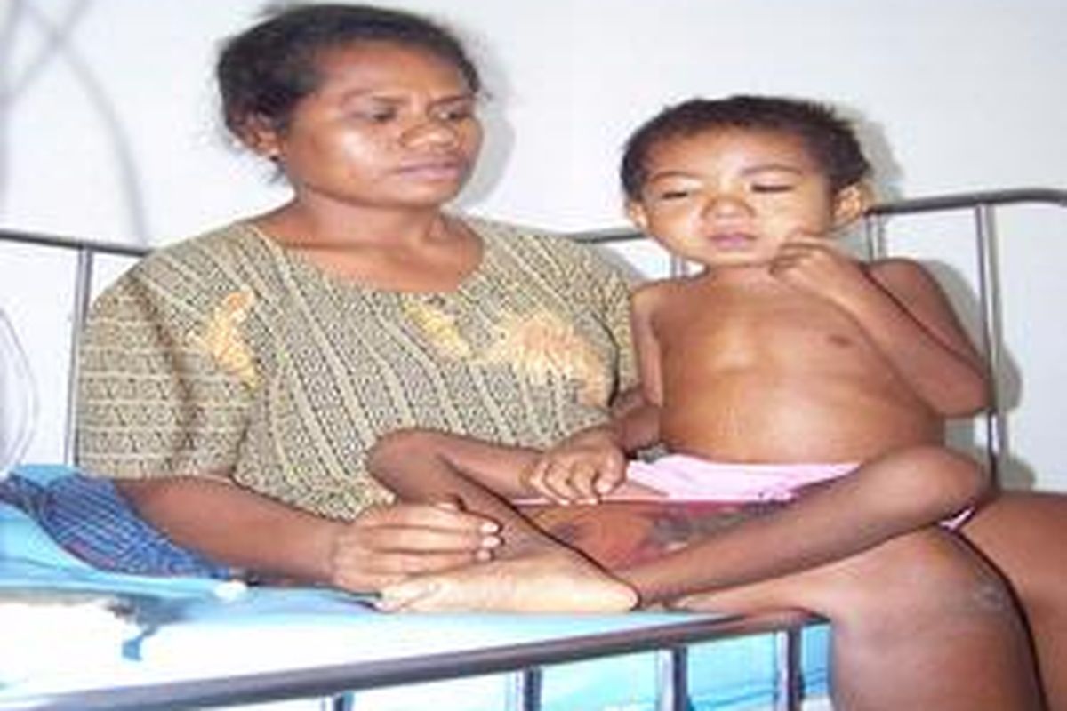 Ny. Monika Uskono sedang memangku anaknya, Rinto Uskono (3,5 tahun), yang menderita komplikasi penyakit diare dan malaria akibat penyakit busung lapar (kwashiorkor) yang dideritanya. Balita ini dirawat di RSUD Kefamenanu dan sudah mendapat donor darah dua kantong untuk menyelamatkan nyawanya. Gambar diambil Rabu(13/8/2008) siang.