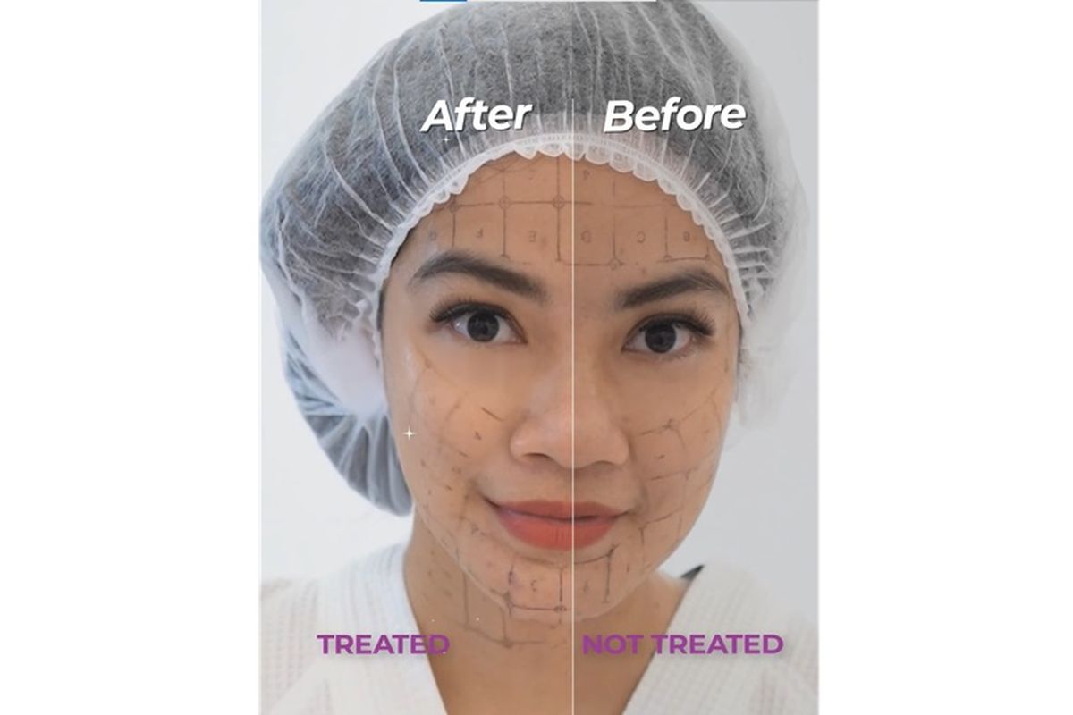 Hasil optimal perawatan dengan Thermage FX akan terlihat secara bertahap dalam 2 minggu hingga 6 bulan setelah perawatan. 