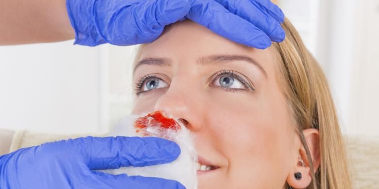 5 Cara Cepat Menghentikan Mimisan