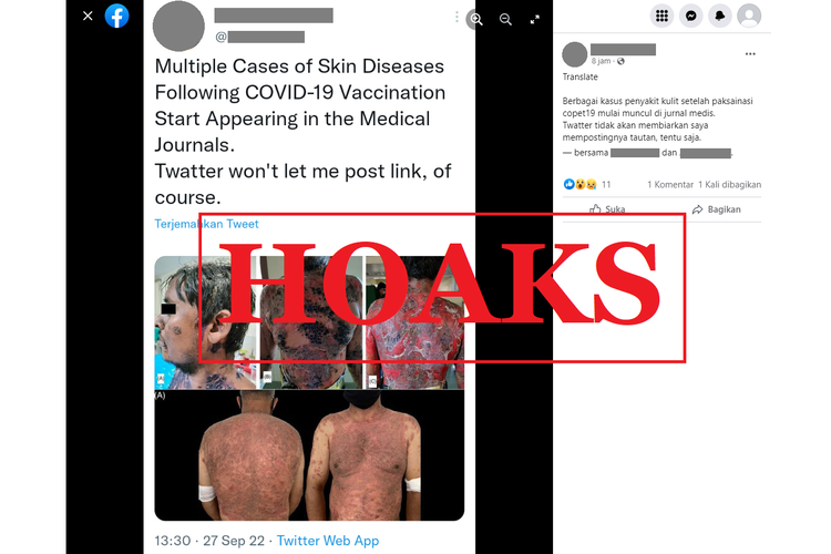 Tangkapan layar unggahan dengan narasi hoaks di sebuah akun Facebook, Rabu (28/9/2022), mengenai vaksin Covid-19 yang menyebabkan berbagai penyakit.