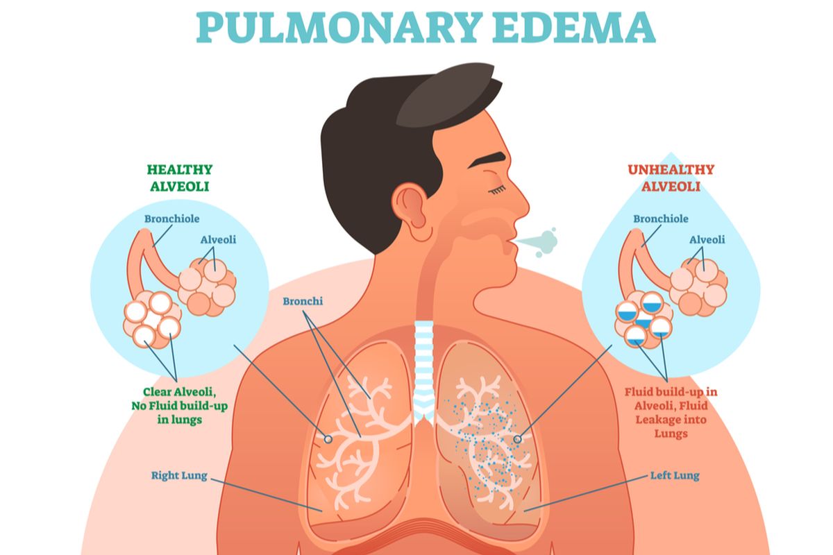 Ilustrasi edema paru