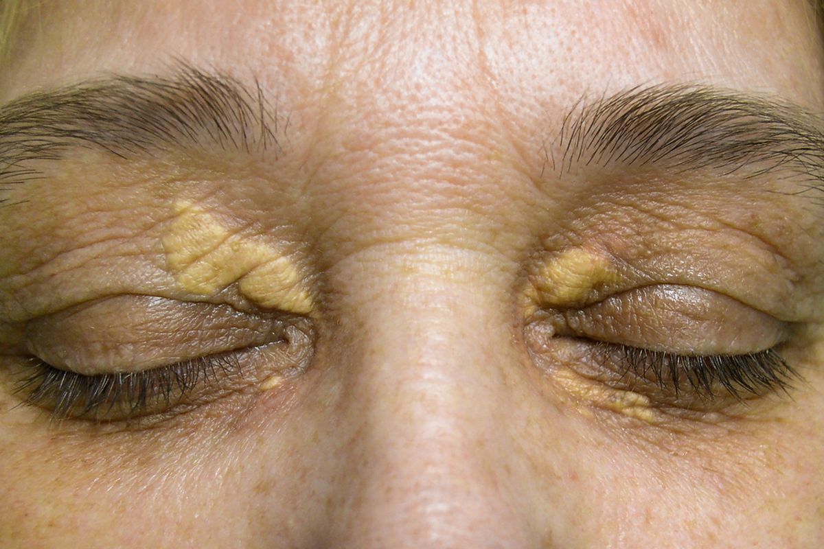 Ilustrasi xanthelasma. Xanthelasma adalah salah satu tanda kolesterol tinggi pada mata. 