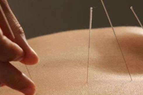 7 Manfaat Akupuntur, Atasi Sakit Kepala hingga Efek Kemoterapi