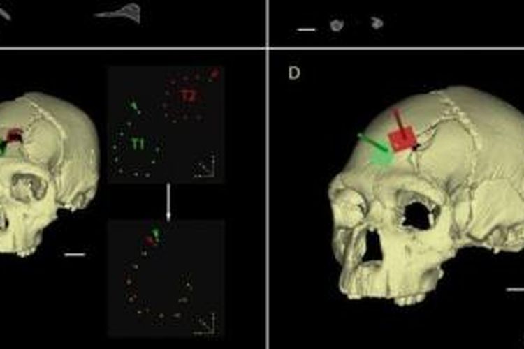 Hasil CT Scan memperlihatkan dua luka tusukan pada tengkorak manusia purba yang ditemukan di dalam sebuah gua bawah tanah di Spanyol.