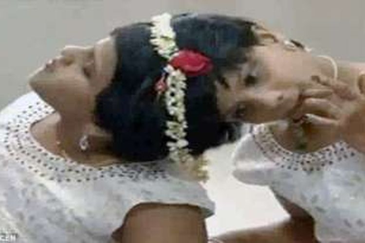 Kembar siam di India, Veena dan Vani telah hidup bersama dengan kepala menyatu selama 14 tahun.