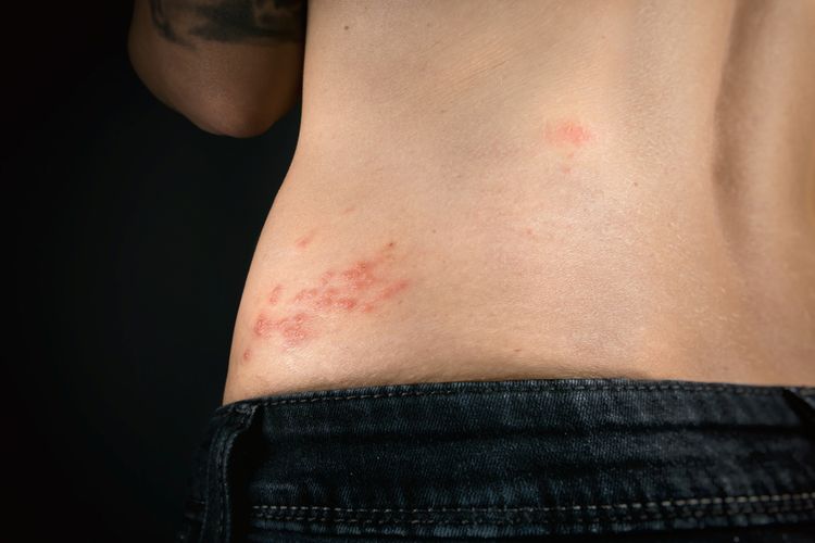 Ilustrasi herpes zoster. Aktor Blake Garrett yang wafat di usia 33 tahun sebelumnya didiagnosis herpes zoster, infeksi virus yang dapat menimbulkan nyeri hebat dan komplikasi serius.