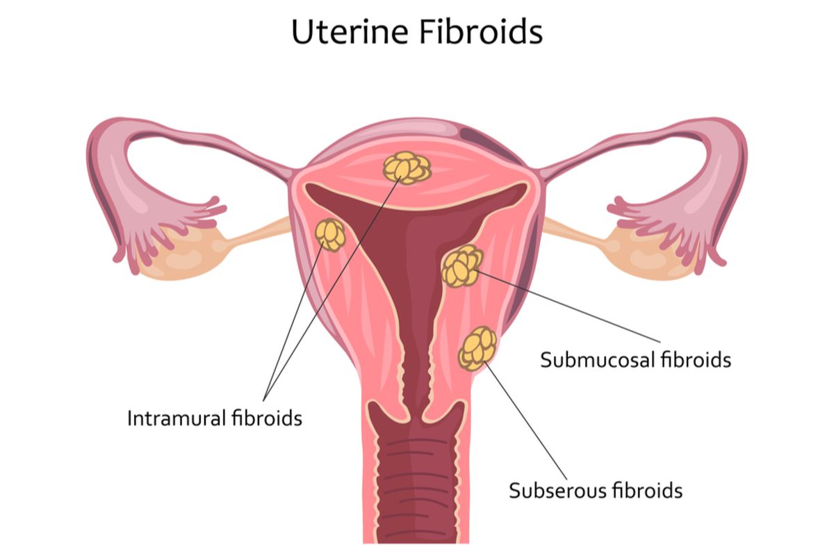 Ilustrasi fibroid rahim. Sejumlah makanan dapat mendukung kesehatan rahim dan menghindarkan wanita dari penyakit, seperti fibroid rahim.  