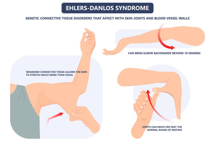 Ilustrasi sindrom Ehlers-Danlos