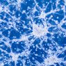 Kanker Otak Glioblastoma: Gejala, Diagnosis, Cara Mengobati