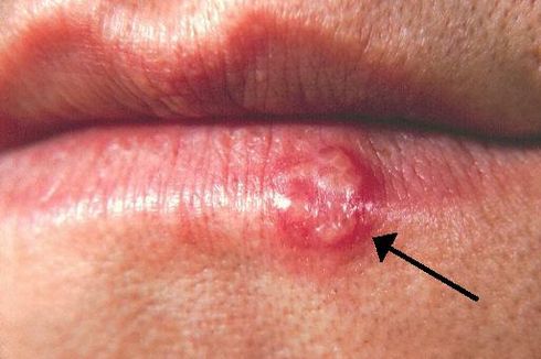 Sering Disembunyikan, Herpes Kelamin Genital bak Fenomena Gunung Es