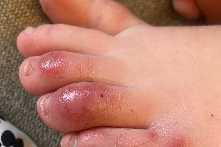 Foto 6 April 2020 yang disediakan oleh Universitas Northwestern ini menunjukkan perubahan warna pada jari kaki pasien remaja tiga hari setelah timbulnya kondisi yang secara informal disebut jari kaki Covid. 