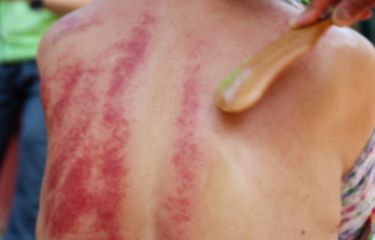 Mengenal Gua Sha, Kerokan ala China untuk Mengatasi Berbagai ...