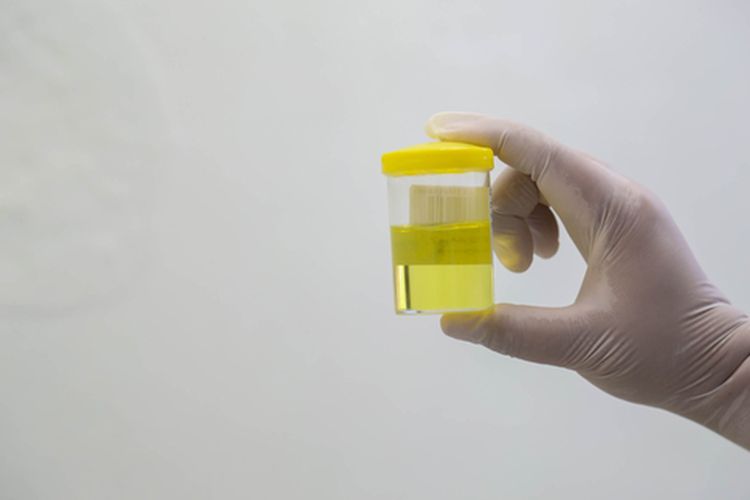 Ilustrasi urine. Peneliti MIT menemukan cara deteksi kanker sederhana dan terjangkau menggunakan urine.