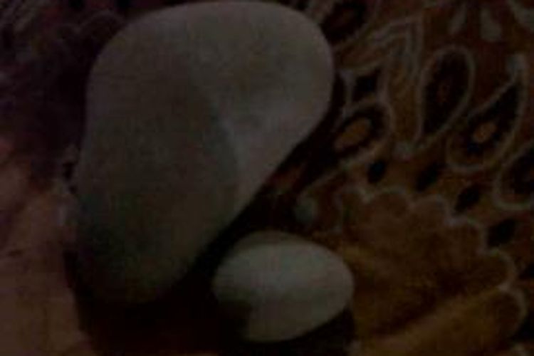 Dua butir batu yang terdapat di dalam kandungan seorang ibu yang melahirkan bersama dengan bayi laki-laki secara operasi Cesar di Rumah Sakit Umum Daerah Ruteng, Senin (6/10/2014) kemarin. Foto ini diambil tadi malam, Rabu (8/10/2014). (Kompas.com/Markus Makur)