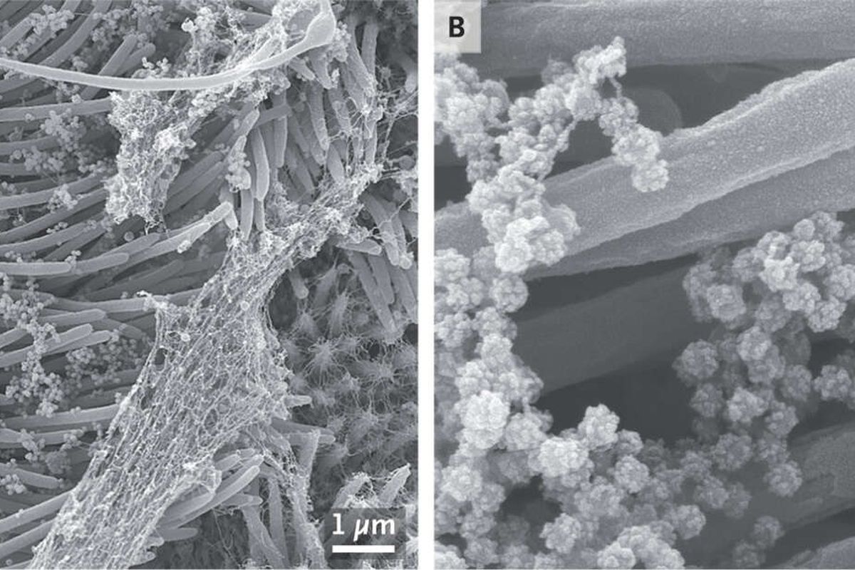 Gambar ini menunjukkan virus corona SARS-CoV-2 menginfeksi sel manusia. Gambar ditangkap dengan menggunakan mikroskop elektron.