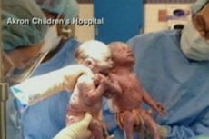 Bayi Kembar AS Lahir Berpegangan Tangan