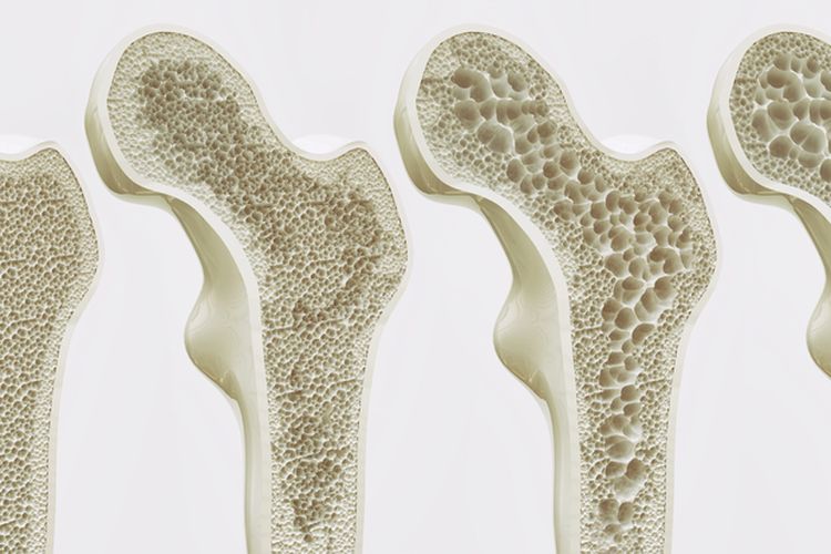 Ilustrasi Osteoporosis