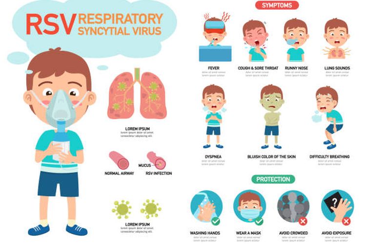 Ilustrasi infografik respiratory syncytial virus (RSV).