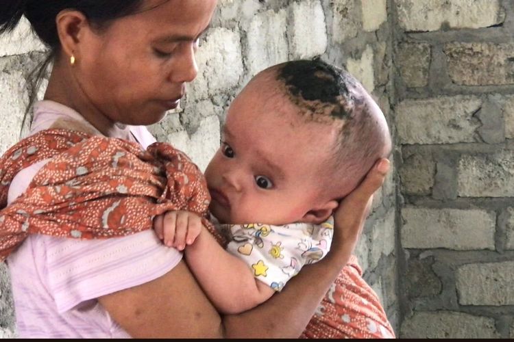 Foto : Yohanes Marianto Sidabutar, bayi berusia empat bulan, asal Kampung Nangka,Desa Terong, Kecamatan Satarmese Barat, Kabupaten Manggarai, NTT, mengidap hidrosefalus dipangku ibundanya, di kediaman mereka, Minggu (25/9/2022).