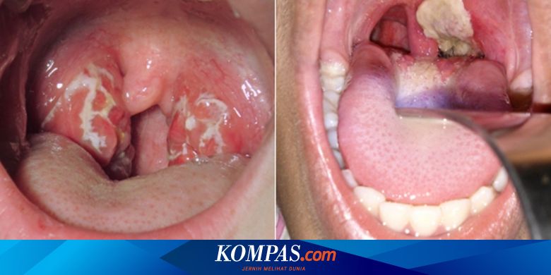 Hati Hati Penyakit Ini Gejalanya Mirip Difteri Ketahui Bedanya