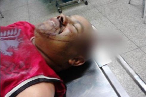 Pisau Menancap di Kepala 3 Jam, Pria Brasil Lolos dari Maut