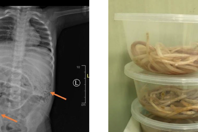 Perut anak di Jember yang dipenuhi cacing hingga tak bisa BAB selama seminggu 