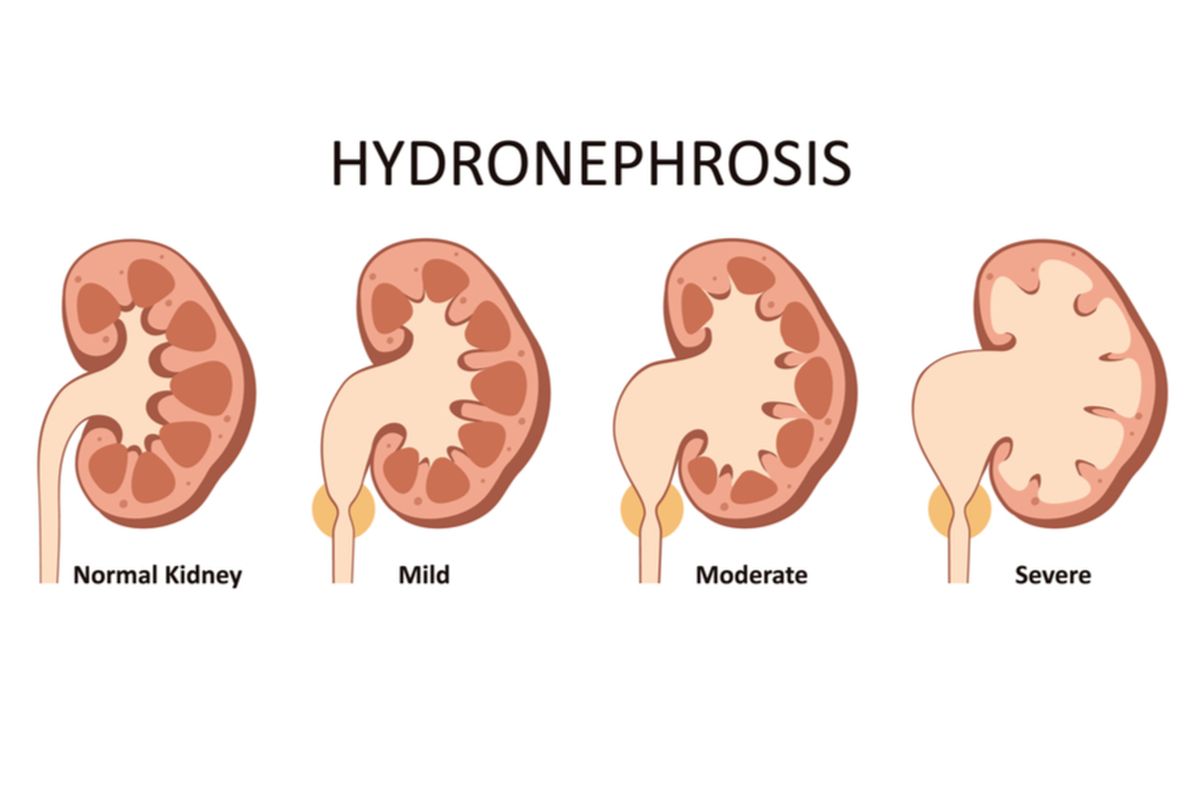 Ilustrasi hidronefrosis