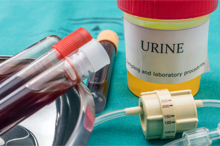 Studi Ungkap Tes Urine Bisa Mendeteksi Kanker Prostat