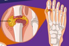 6 Cara Alami untuk Menekan Kadar Asam Urat, Sudah Tahu?