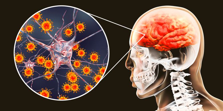Ilustrasi radang otak, meningitis