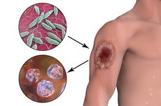 Mengenal Leishmaniasis, Penyakit Kulit yang Sulit Sembuh