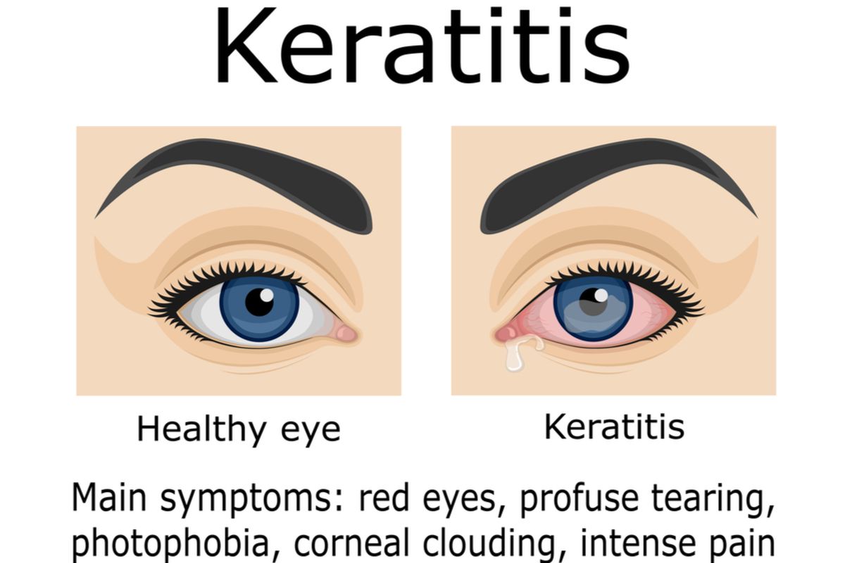 Ilustrasi keratitis