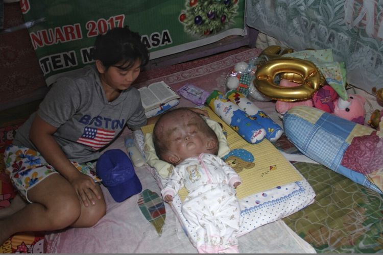 Filia Legoh (1) bayi yang menderita hidrocepalus ditemani ibunya, Gita Samola (22) di rumah mereka di Tondano Barat, Minahasa. 
