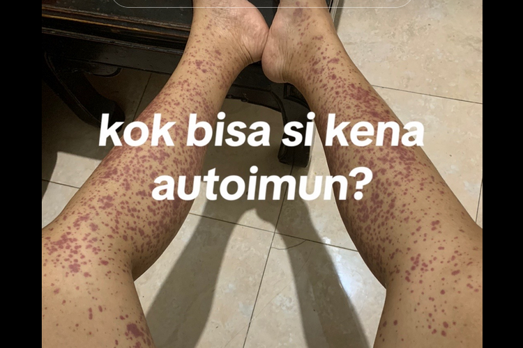 Kisah Della, Menderita Autoimun Diduga karena Sering Jajan di Luar