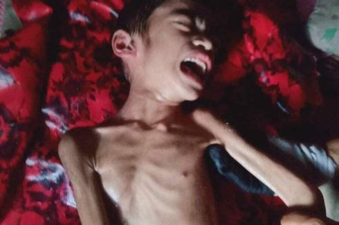 Kisah Pilu Bocah 7 Tahun di Manggarai Timur, Terbaring Lemah karena Komplikasi, Butuh Biaya Pengobatan