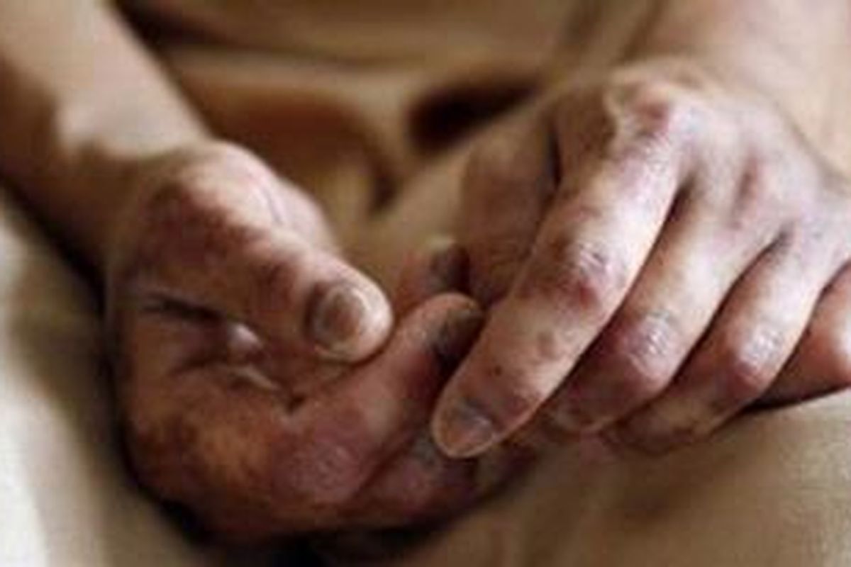 Tangan Wifa yang lebam karena dianiaya