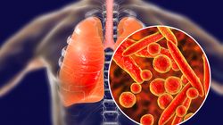 Kemenkes Ungkap Gejala Utama Pasien Terjangkit Mycoplasma Pneumoniae