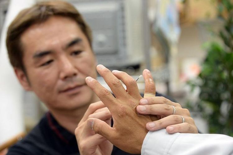 Banyak mantan anggota yakuza yang mempraktikkan yubitsume merekonstruksi jari kelingking mereka dengan prostesis agar dapat berintegrasi kembali ke dalam masyarakat Jepang.