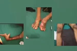 Tubuh Terbakar Saat Lembur, Pekerja Jambi Mengaku Diminta Tulis Kecelakaan Terjadi di Rumah