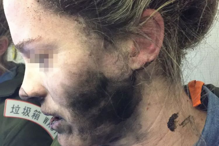 Seorang wanita jadi korban ledakan headphone yang sedang dipakainya