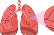 Kanker Paru ALK Positif yang Cepat Memburuk Kini Bisa Ditangani